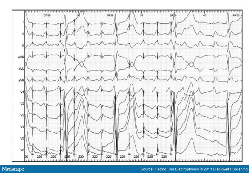 12ECG Entrainment with fusion