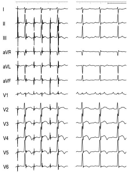 Atrial Pace Mapping (ECG)