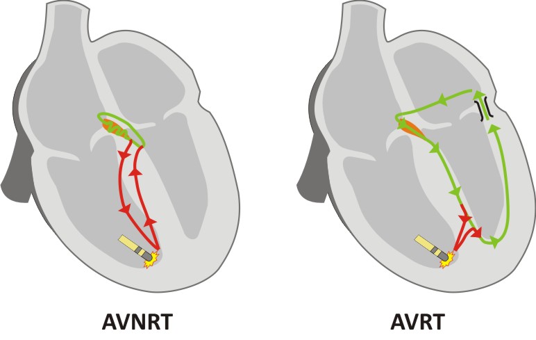 Entrainment pattern - AVNRT versus AVRT