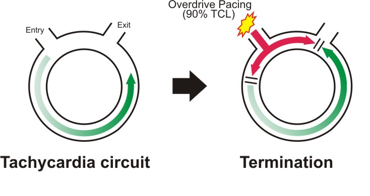 Diagram_-_Overdrive_Pacing_termination